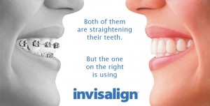 Invisalign Braces in Essex