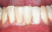 case1 after
